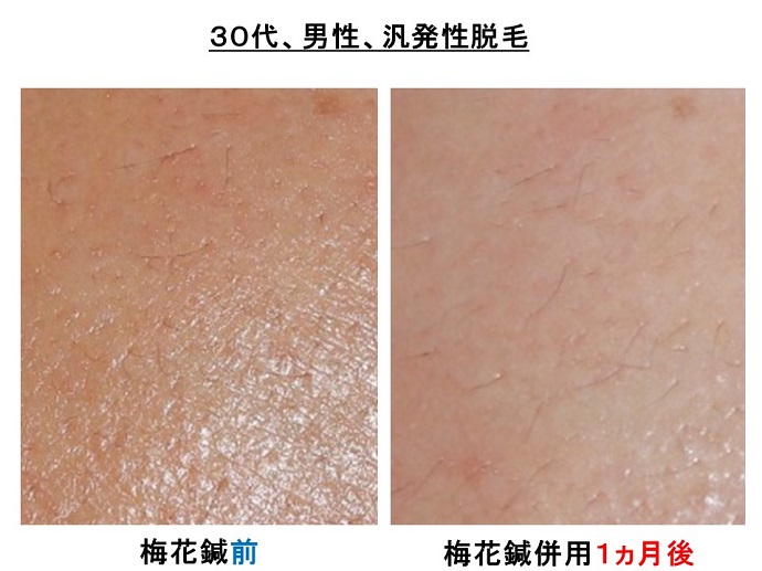 汎発性脱毛　病院